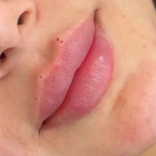 RA Aesthetics treatment result on Instagram