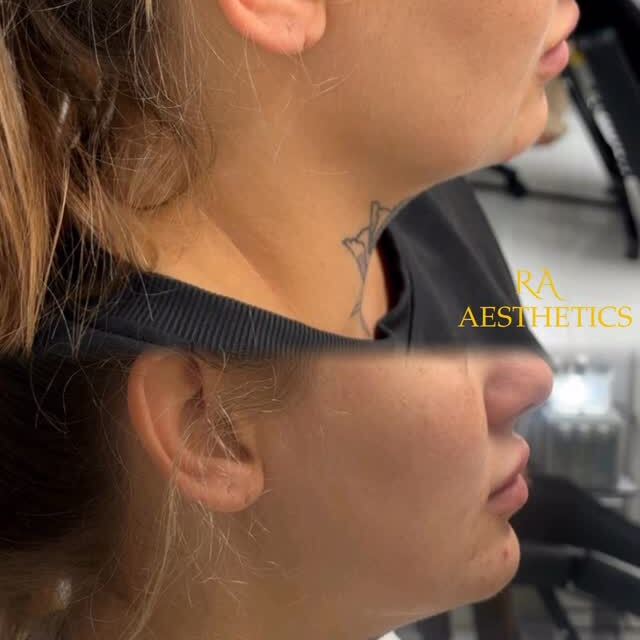 RA Aesthetics treatment result on Instagram