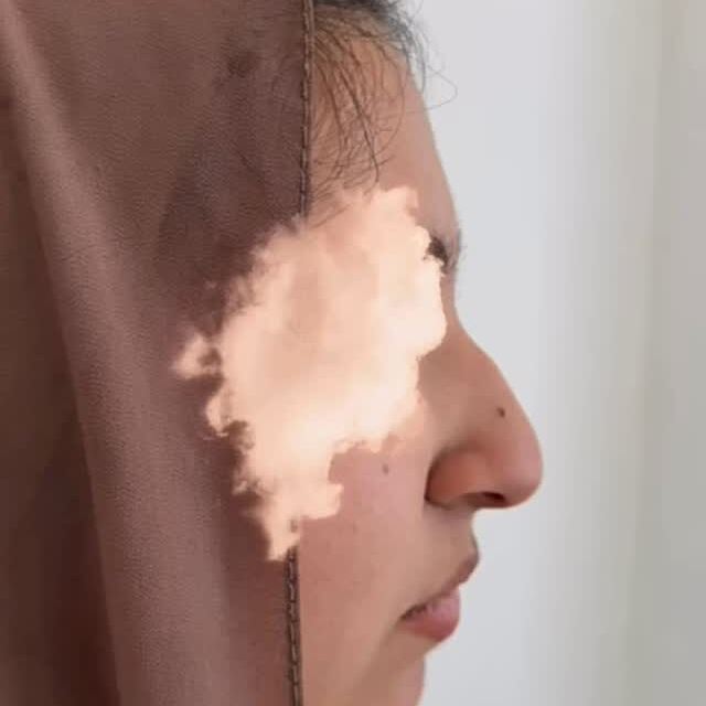 RA Aesthetics treatment result on Instagram
