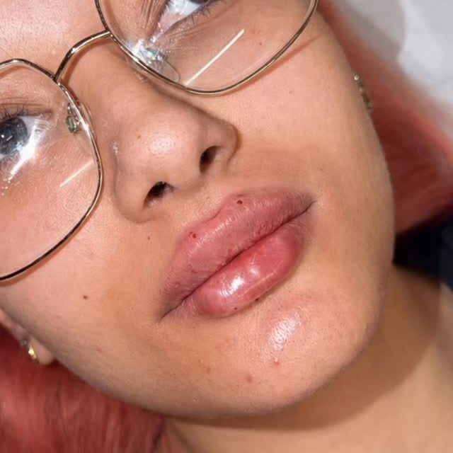 RA Aesthetics treatment result on Instagram